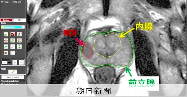 前立腺がんの危険因子