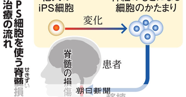 脊髄損傷、iPS有効の可能性 慶大4人移植、2人は一部の運動機能