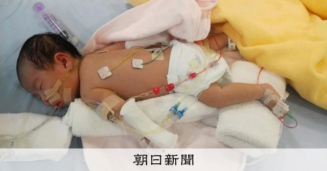 生後1カ月の娘、百日せき耐性菌で人工呼吸器　母が感じた命の危機