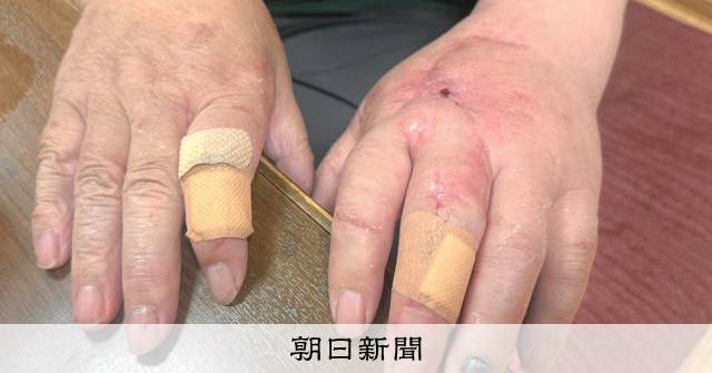 革手袋が盾に、ヒグマ襲撃から生還も後遺症　ハンターの覚悟